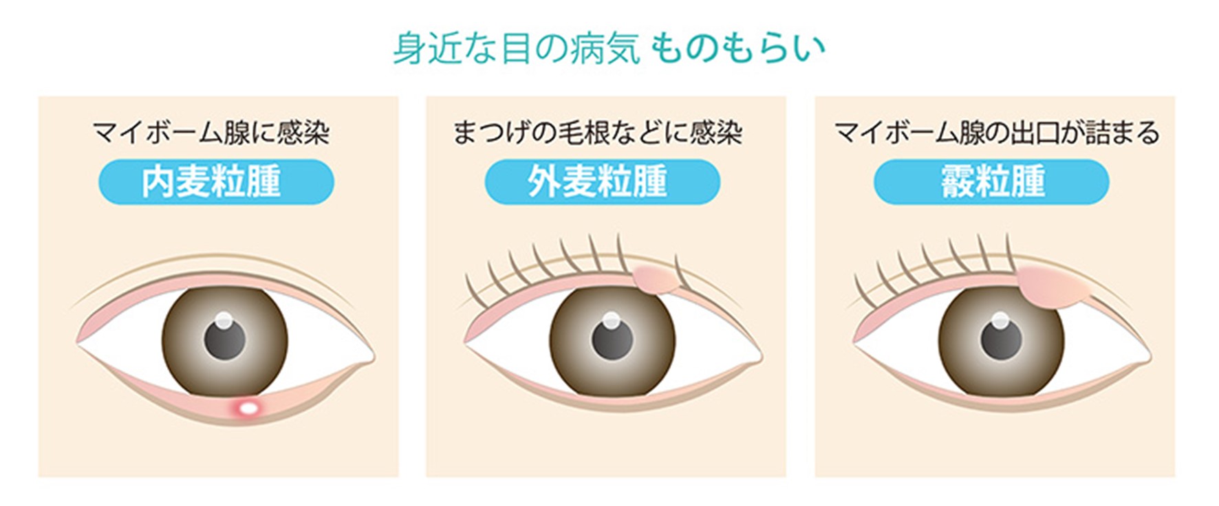 ものもらいの種類